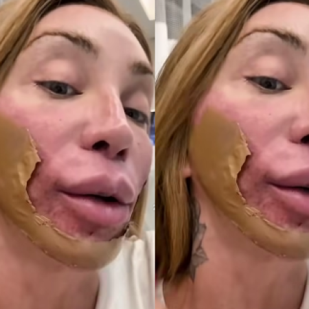 Maya Massafera passa por procedimento estético que “destrói a pele”; entenda!